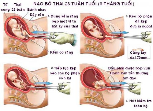 nao-hut-thai-co-dau-khong